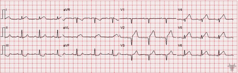 Hyperacute T Waves | ECG Stampede