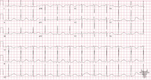 Hypokalemia | ECG Stampede