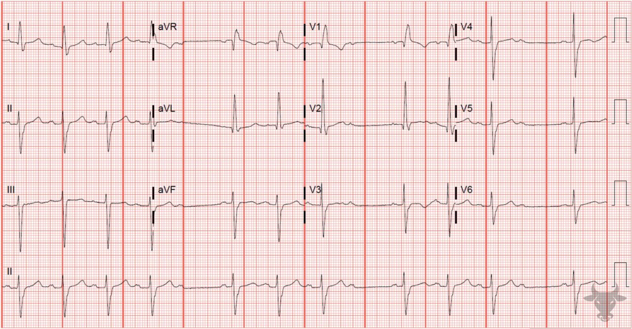 Trifascicular Block | ECG Stampede