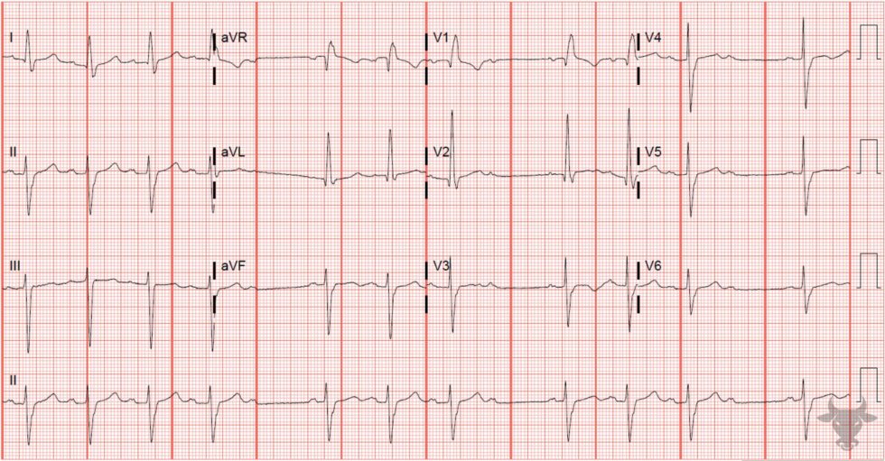 Trifascicular Block | ECG Stampede