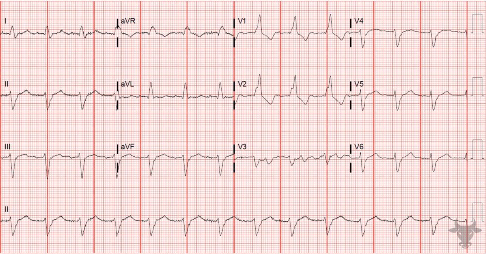 Left Anterior Fascicular Block | ECG Stampede