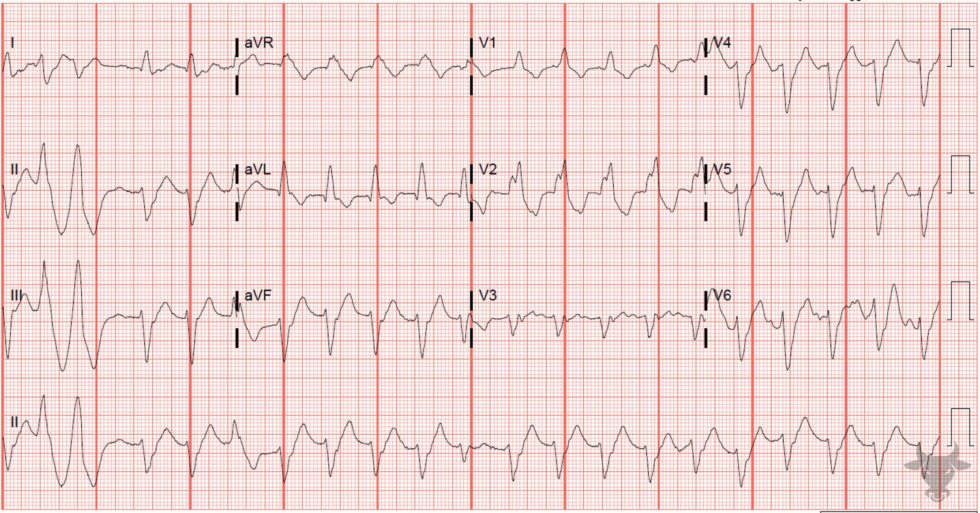 Trifascicular Block | ECG Stampede