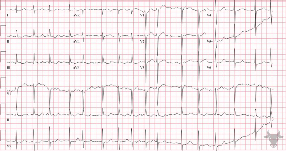 Sinus Node Dysfunction | ECG Stampede