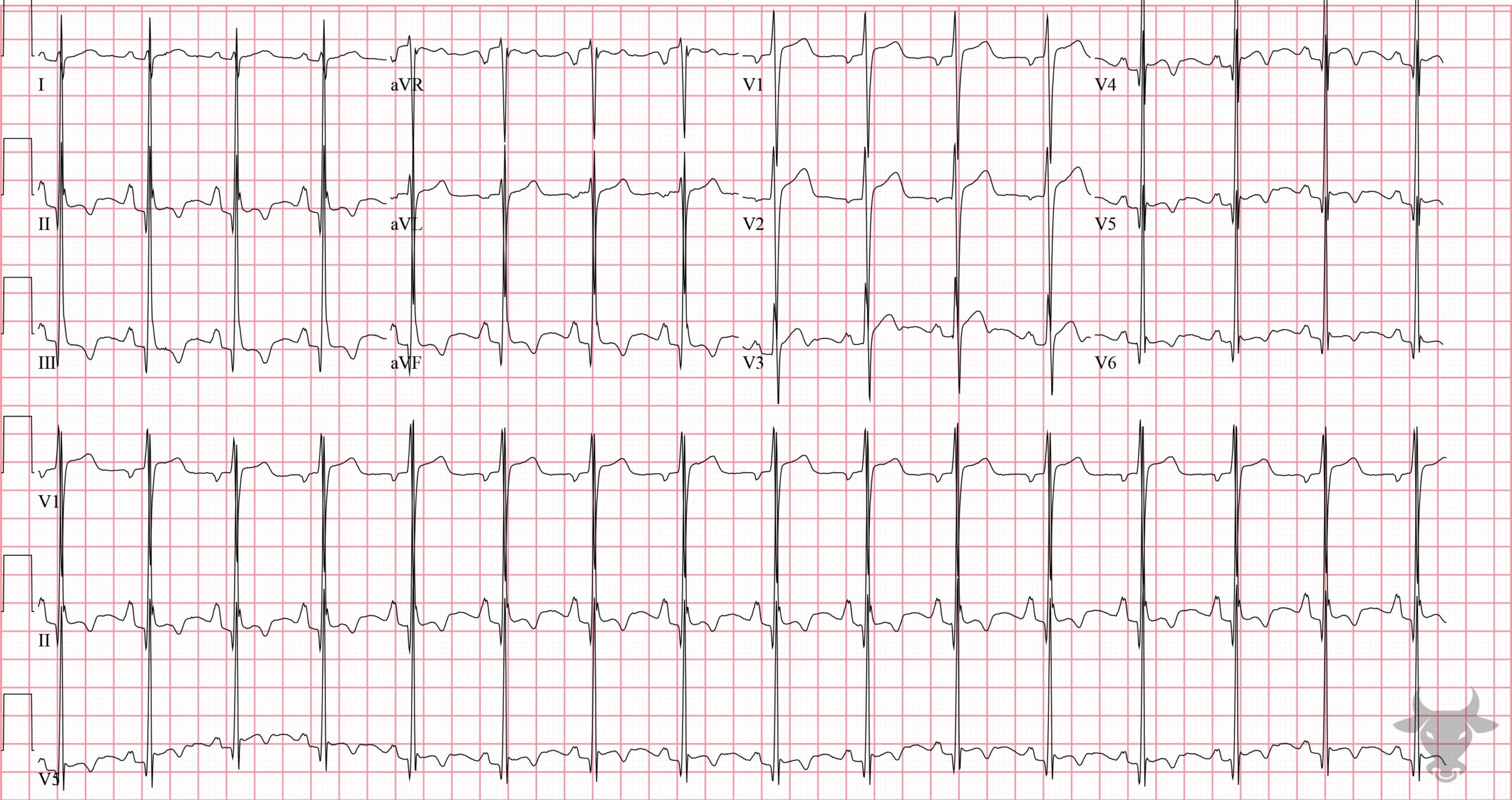 Right Atrial Enlargement ECG Stampede