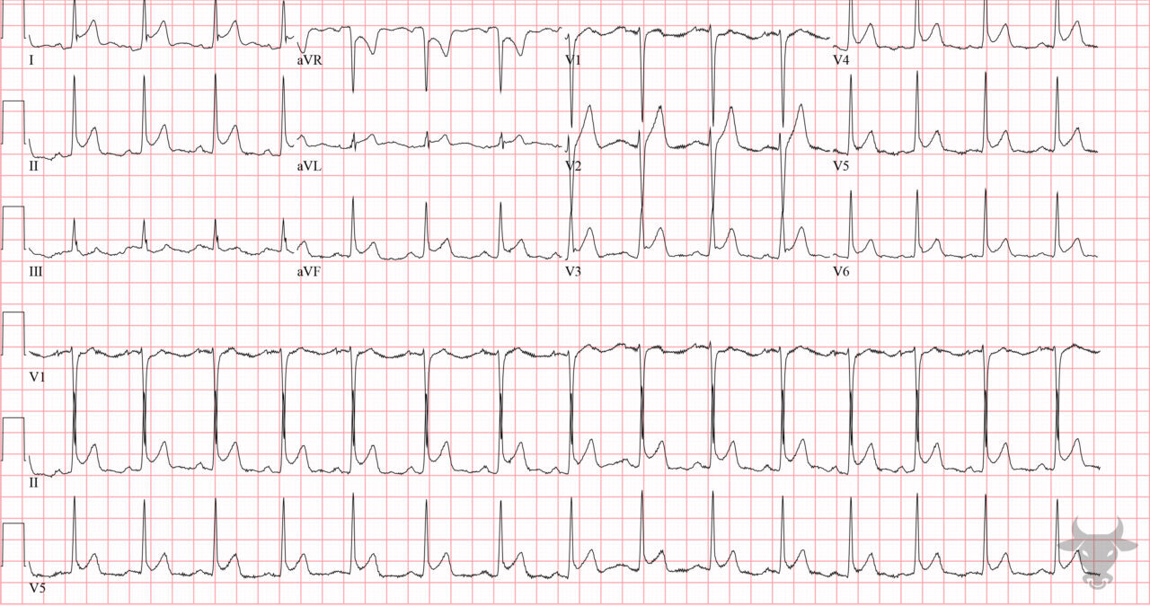 Acute Pericarditis 