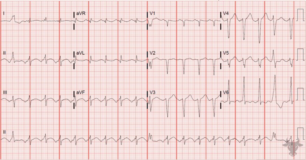 Atrial Tachycardia | ECG Stampede