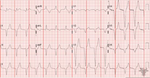 Accelerated Idioventricular Rhythm | ECG Stampede