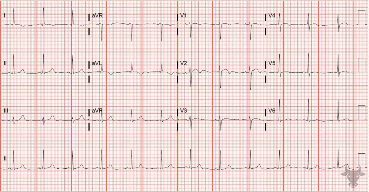 T-wave Inversions | ECG Stampede