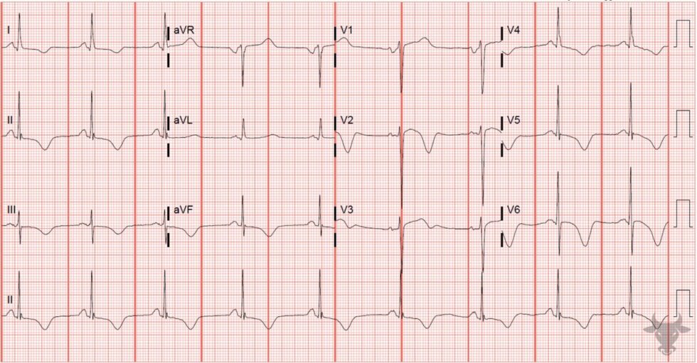 Cerebral T waves | ECG Stampede