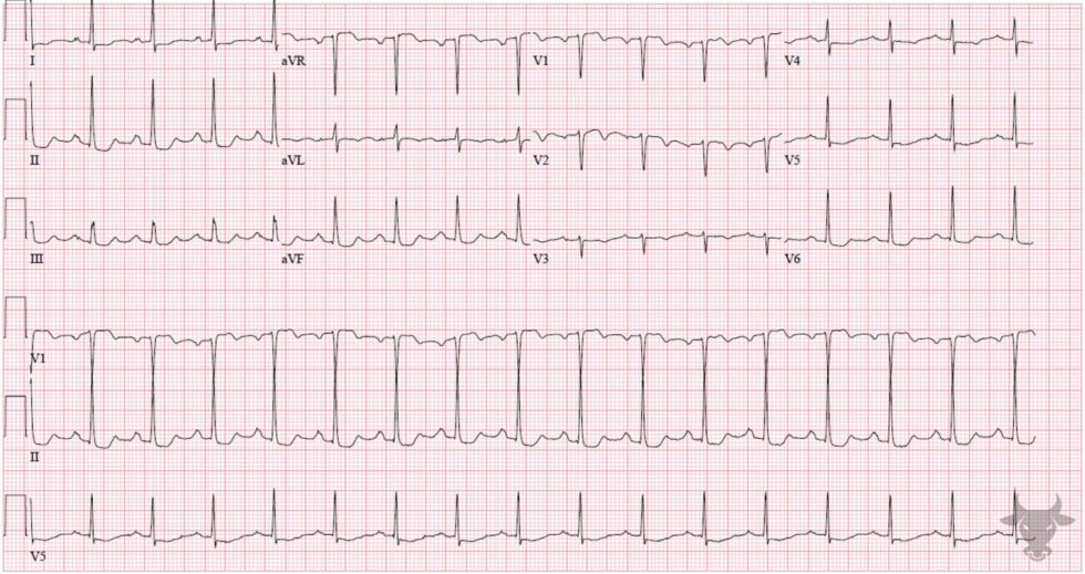 Global Subendocardial Ischemia | ECG Stampede