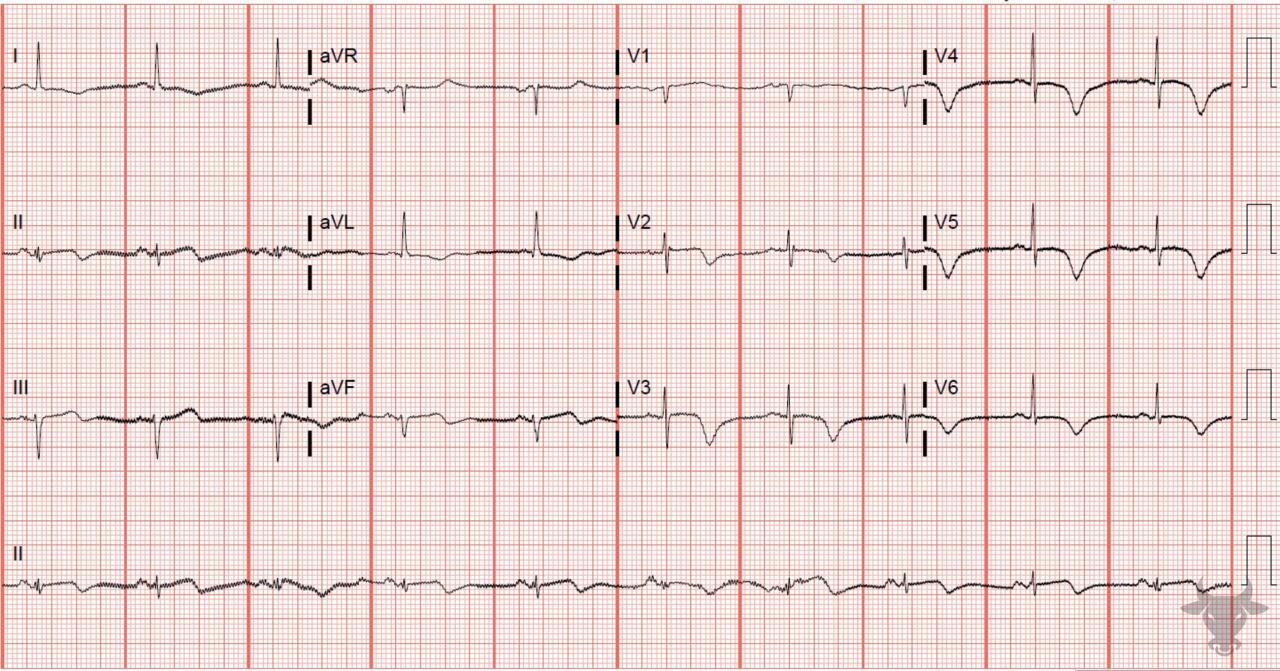 T-wave Inversions | ECG Stampede