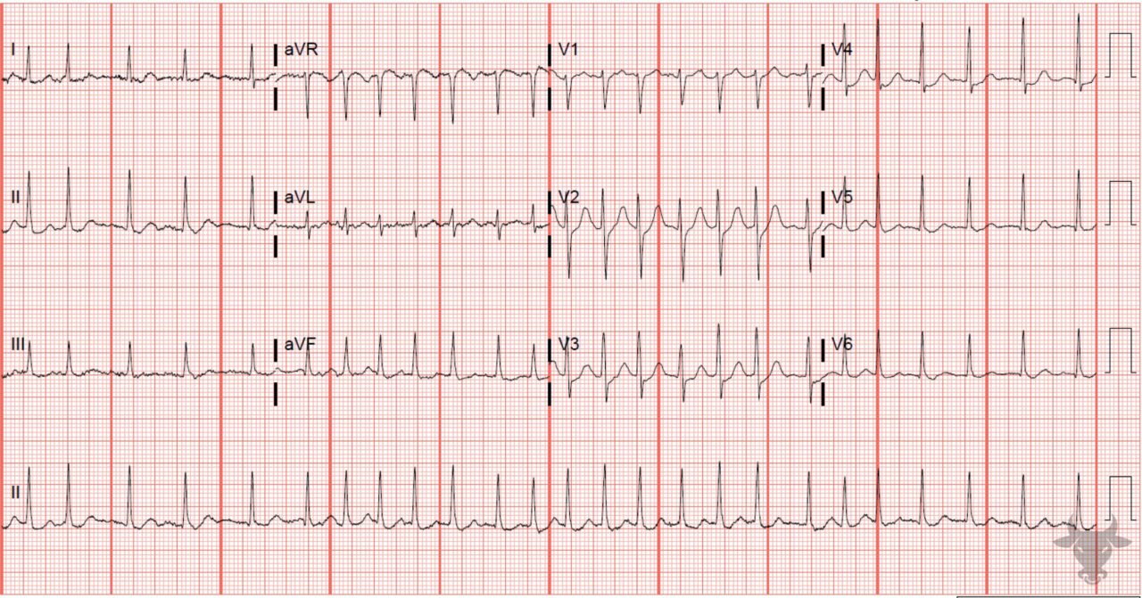 Atrial Fibrillation | ECG Stampede