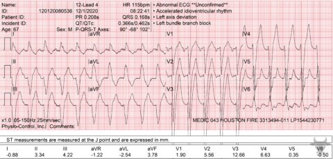 First Degree Atrioventricular Block | ECG Stampede