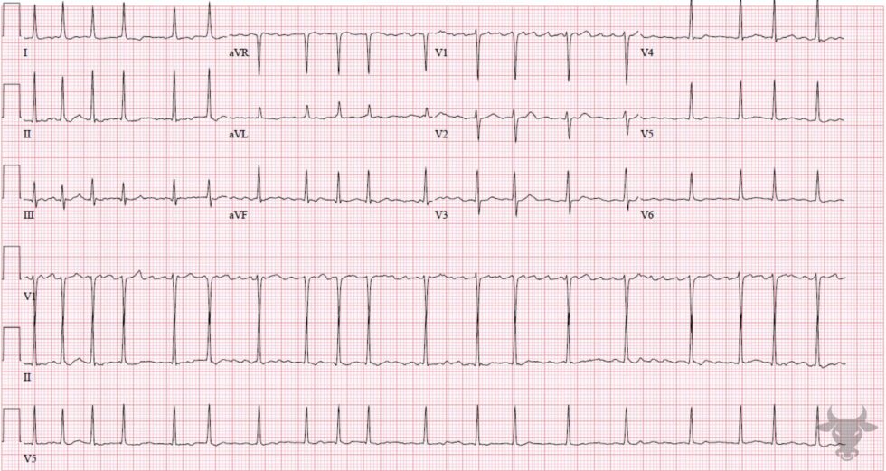 Atrial Fibrillation | ECG Stampede