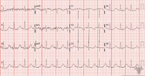 Hypokalemia | ECG Stampede