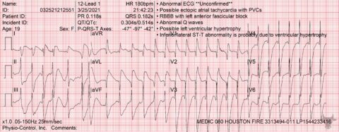 Ventricular Tachycardia | ECG Stampede