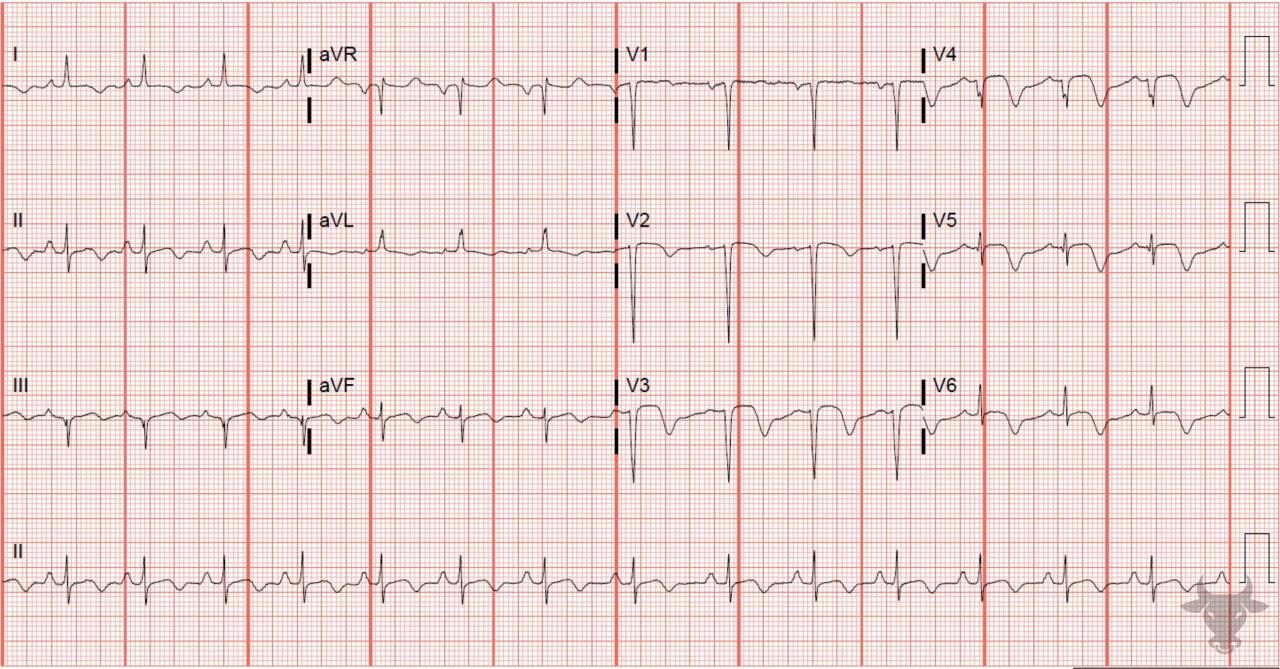 T-wave Inversions | ECG Stampede