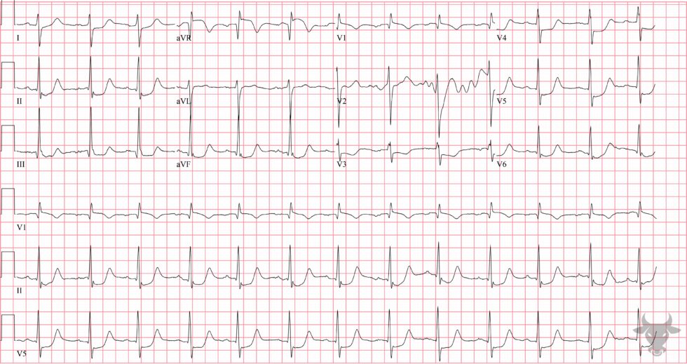 Global Subendocardial Ischemia | ECG Stampede