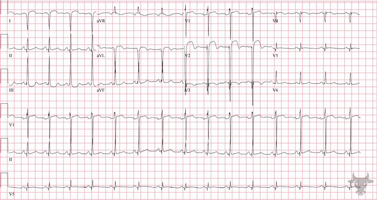 Left Ventricular Aneurysm | ECG Stampede