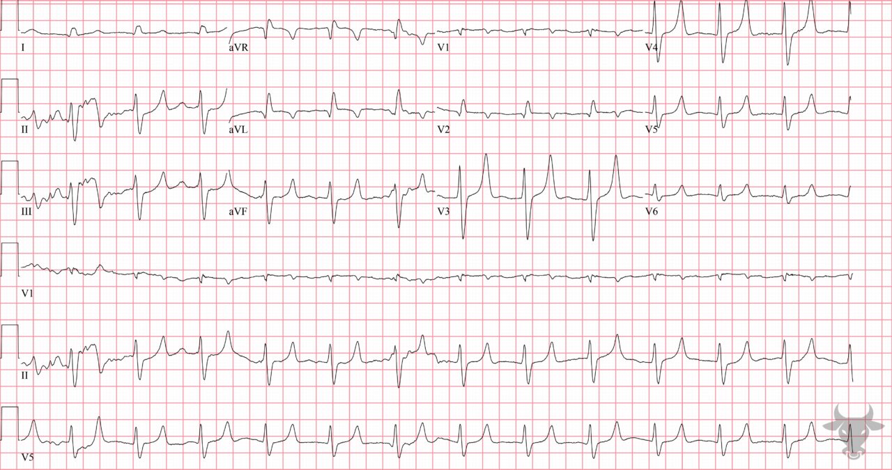 Hyperkalemia 