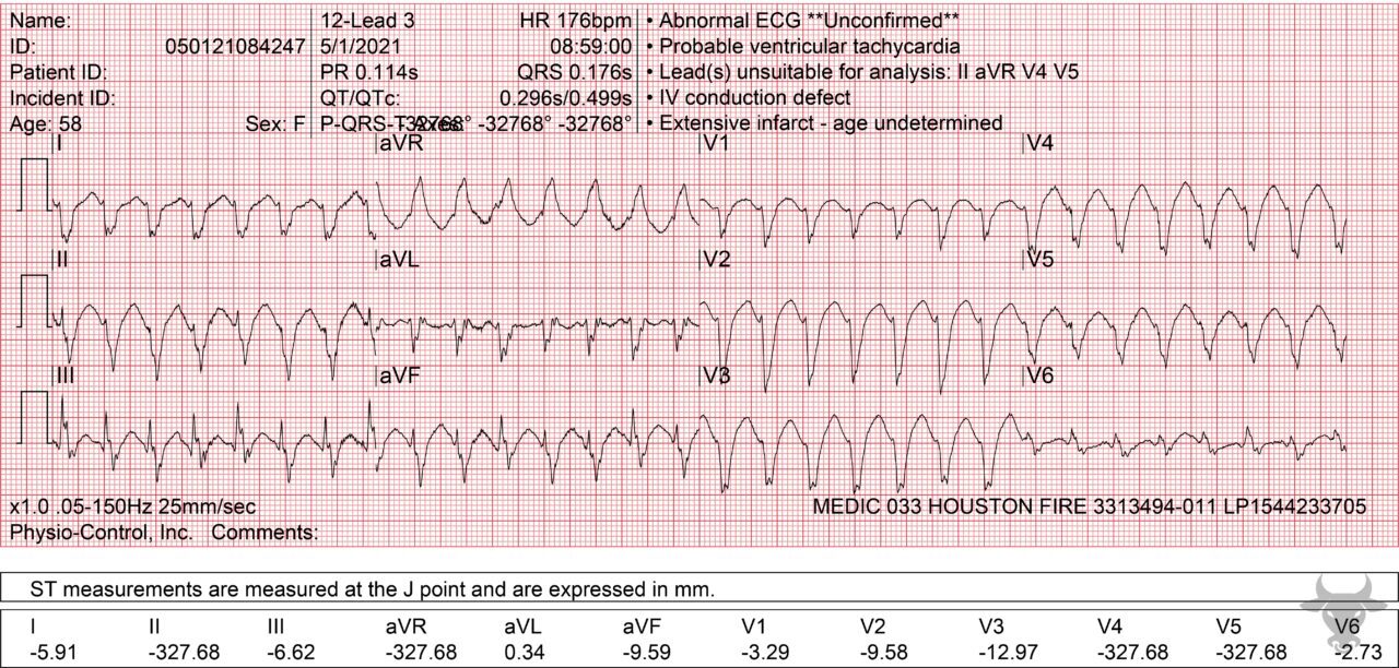 Ventricular Tachycardia | ECG Stampede