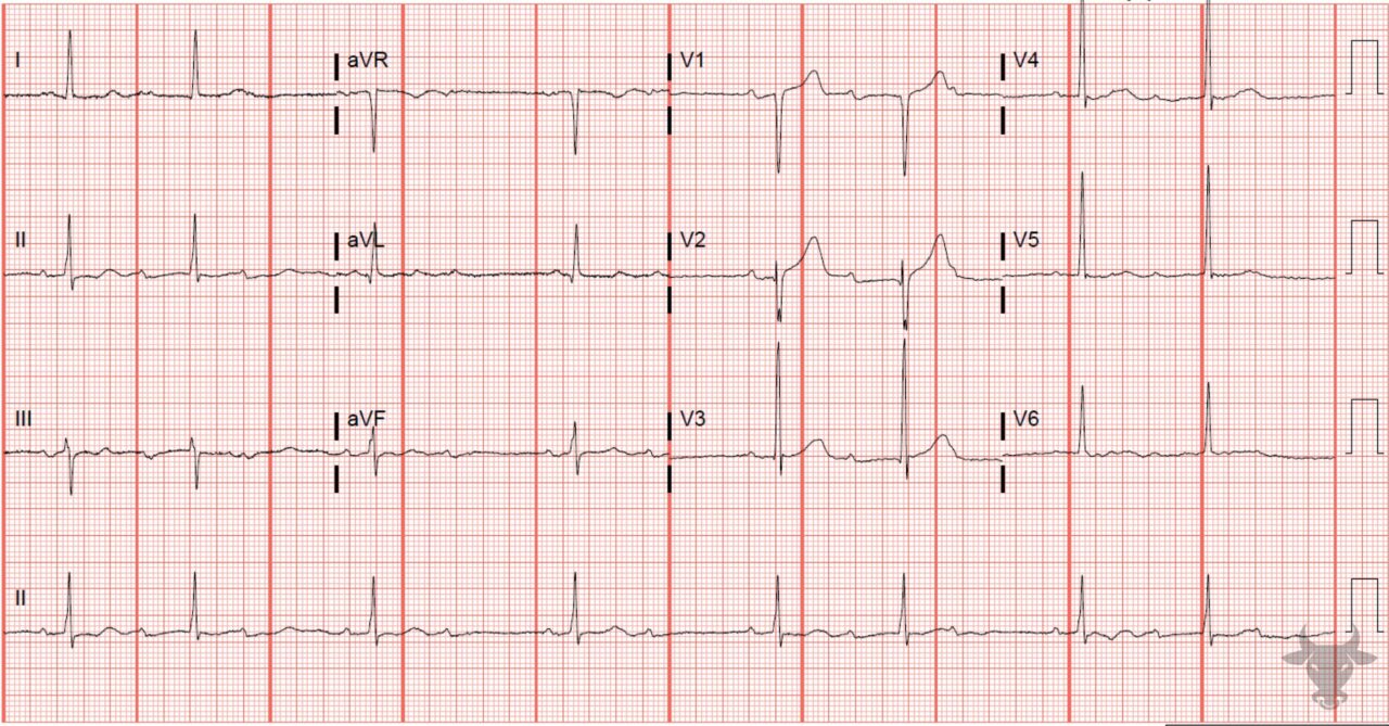 Second Degree Atrioventricular Block – Mobitz I | ECG Stampede