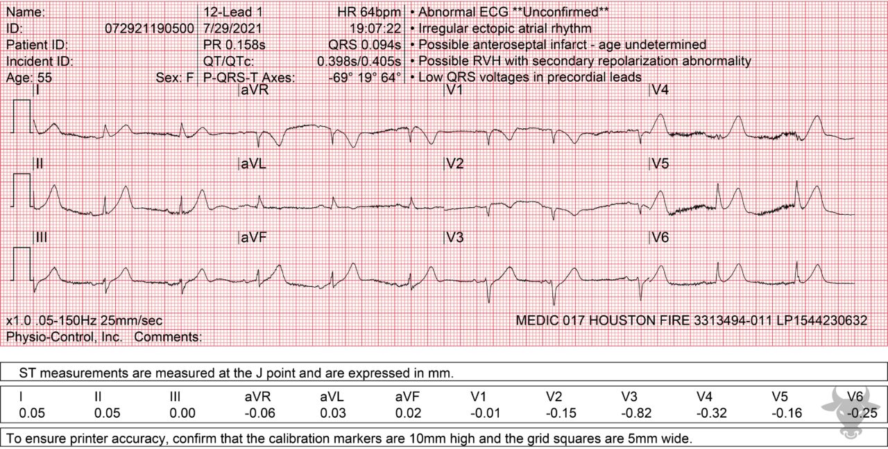 Hyperacute T Waves 