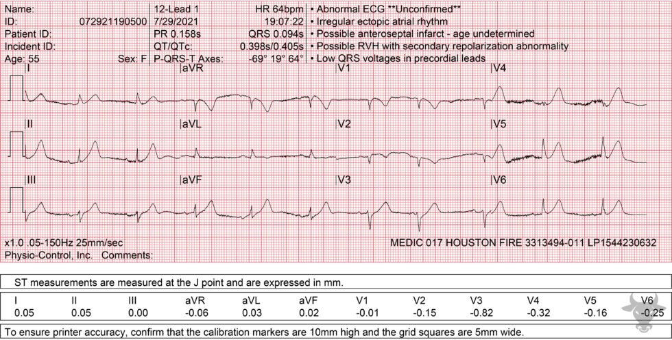 Hyperacute T Waves | ECG Stampede