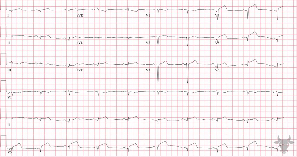 ST-elevation Myocardial Infarction | ECG Stampede