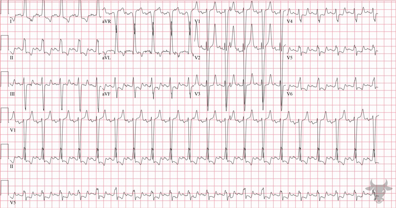 Hyperkalemia | ECG Stampede