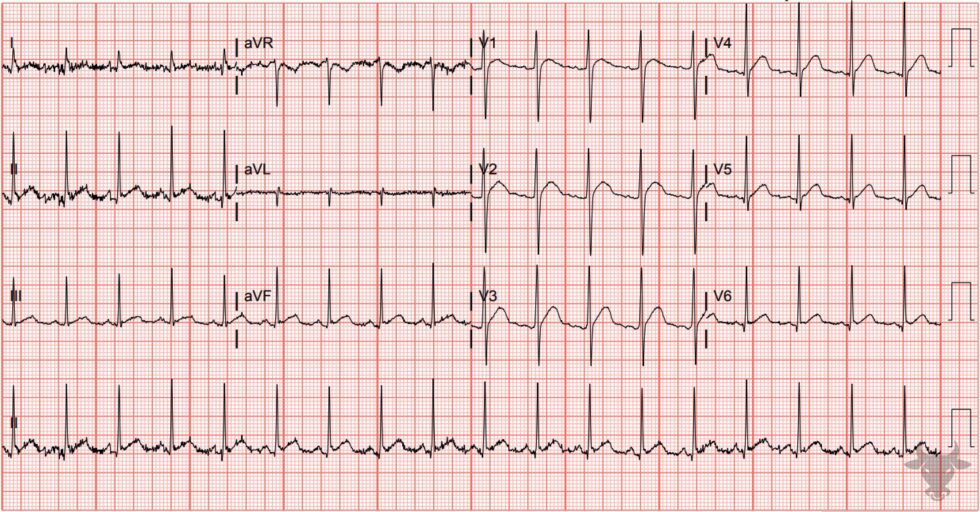 Hypercalcemia | ECG Stampede