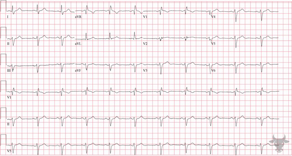 Bifascicular Block | ECG Stampede