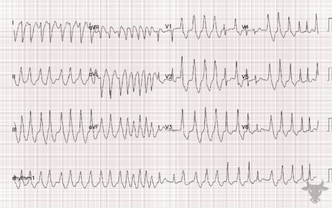 Atrial Fibrillation with WPW | ECG Stampede