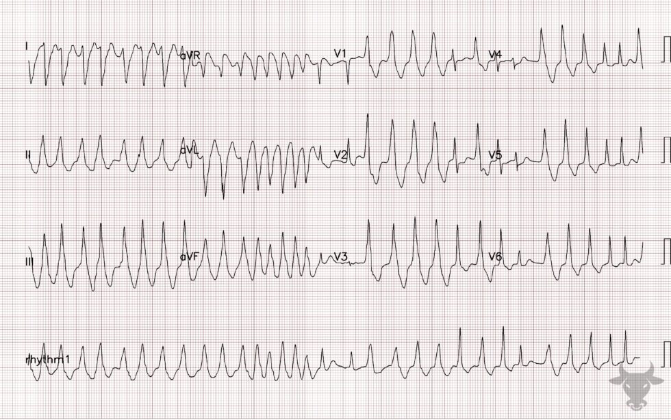 Atrial Fibrillation with WPW | ECG Stampede