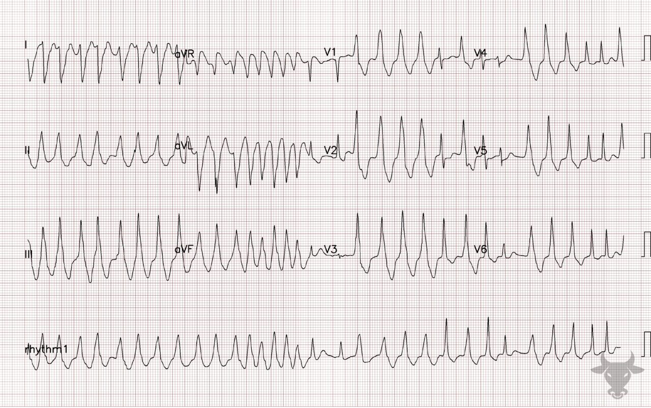 Ventricular Pre-excitation | ECG Stampede