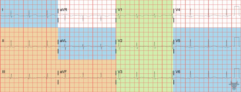 ST-elevation Myocardial Infarction | ECG Stampede