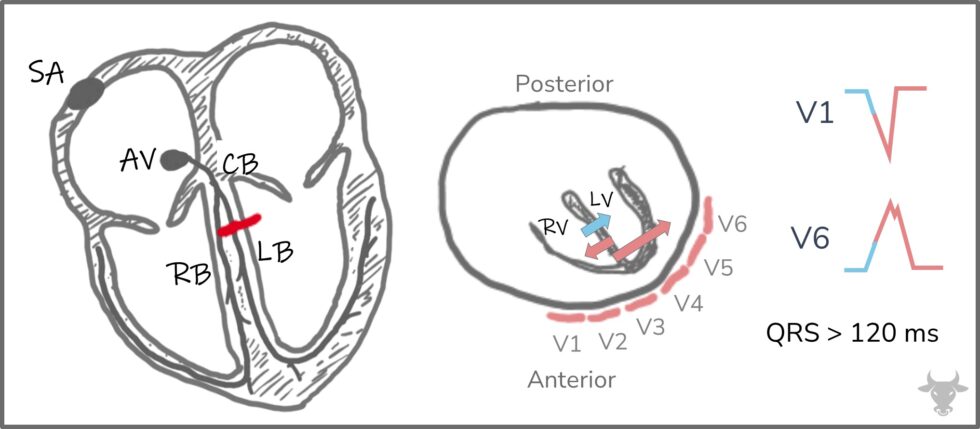 Left Bundle Branch Block | ECG Stampede