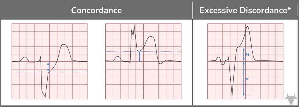 Sgarbossa Criteria | ECG Stampede