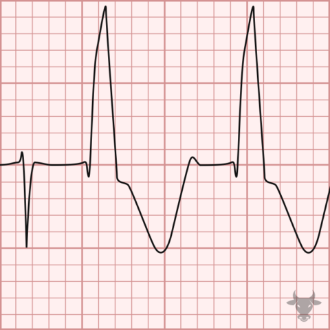 Ashman Phenomenon | ECG Stampede