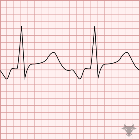 Atrial Tachycardia | ECG Stampede