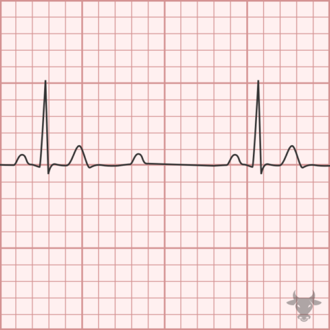 Second Degree Atrioventricular Block 2:1 | ECG Stampede