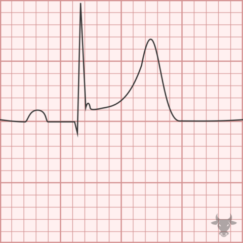 Early Repolarization | ECG Stampede