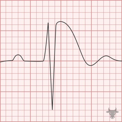 Brugada Syndrome | ECG Stampede