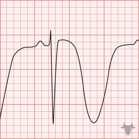 Cerebral T waves | ECG Stampede