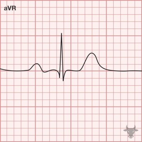 Limb Lead Reversal 