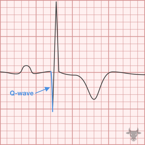 Hypertrophic Cardiomyopathy | ECG Stampede