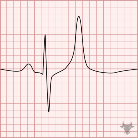 Hyperkalemia | ECG Stampede