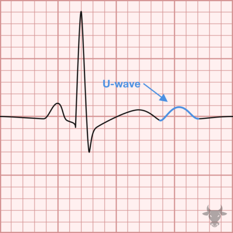 Hypokalemia | ECG Stampede