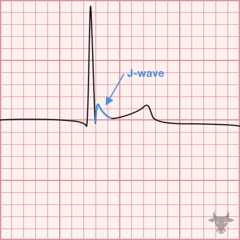 Hypothermia | ECG Stampede