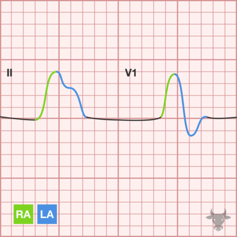 Left Atrial Enlargement | ECG Stampede